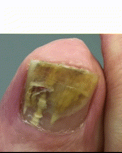 Clearanail® treatment animation